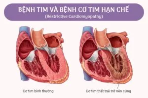 Bác sĩ đang phân tích kết quả siêu âm tim và hình ảnh học trong chẩn đoán bệnh cơ tim hạn chế