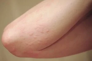 Sơ đồ đại cương bệnh dị ứng miễn dịch trong y học