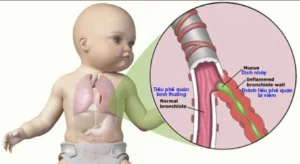 Bác sĩ đang khám hô hấp cho trẻ nhỏ bị viêm tiểu phế quản cấp