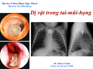 Sơ đồ và tài liệu hướng dẫn xử trí dị vật trong tai mũi họng