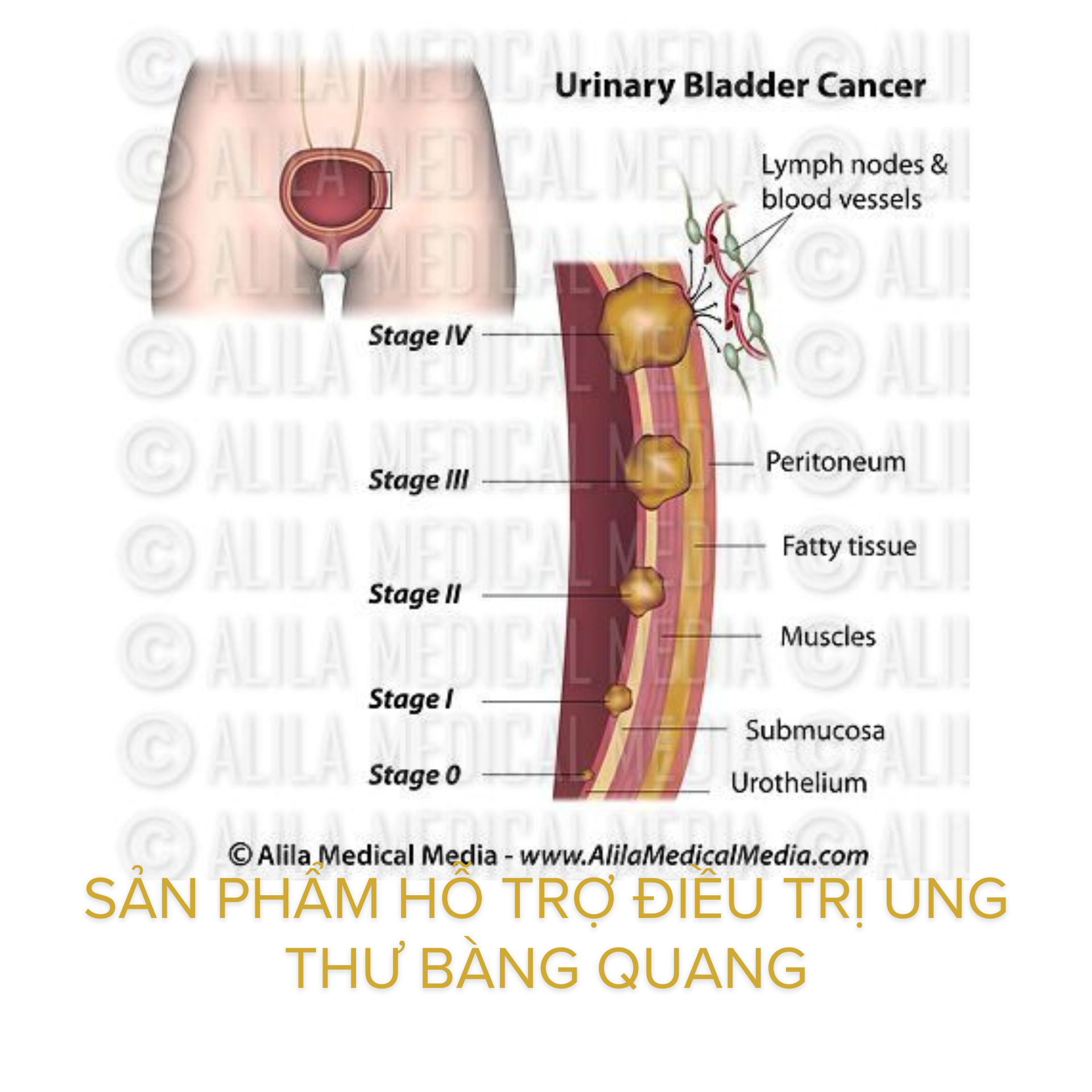 Sản phẩm hỗ trợ điều trị ung thư bàng quang