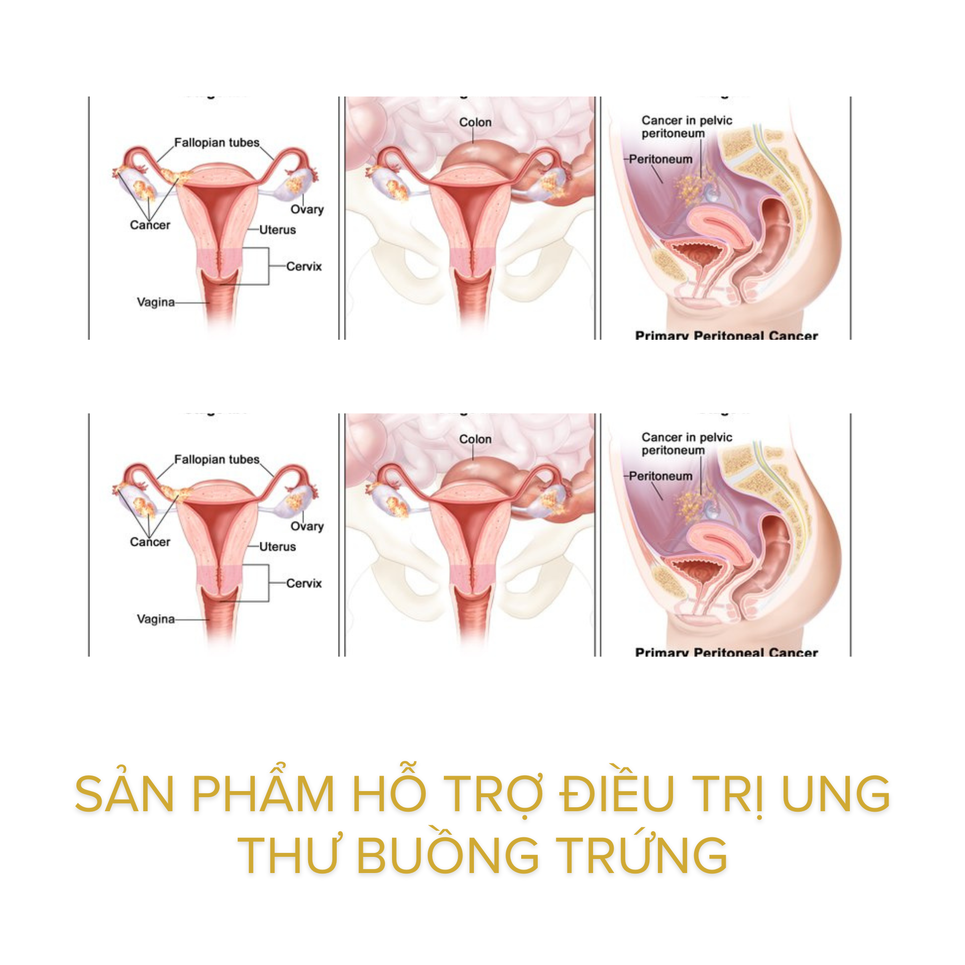 Sản phẩm hỗ trợ điều trị ung thư buồng trứng