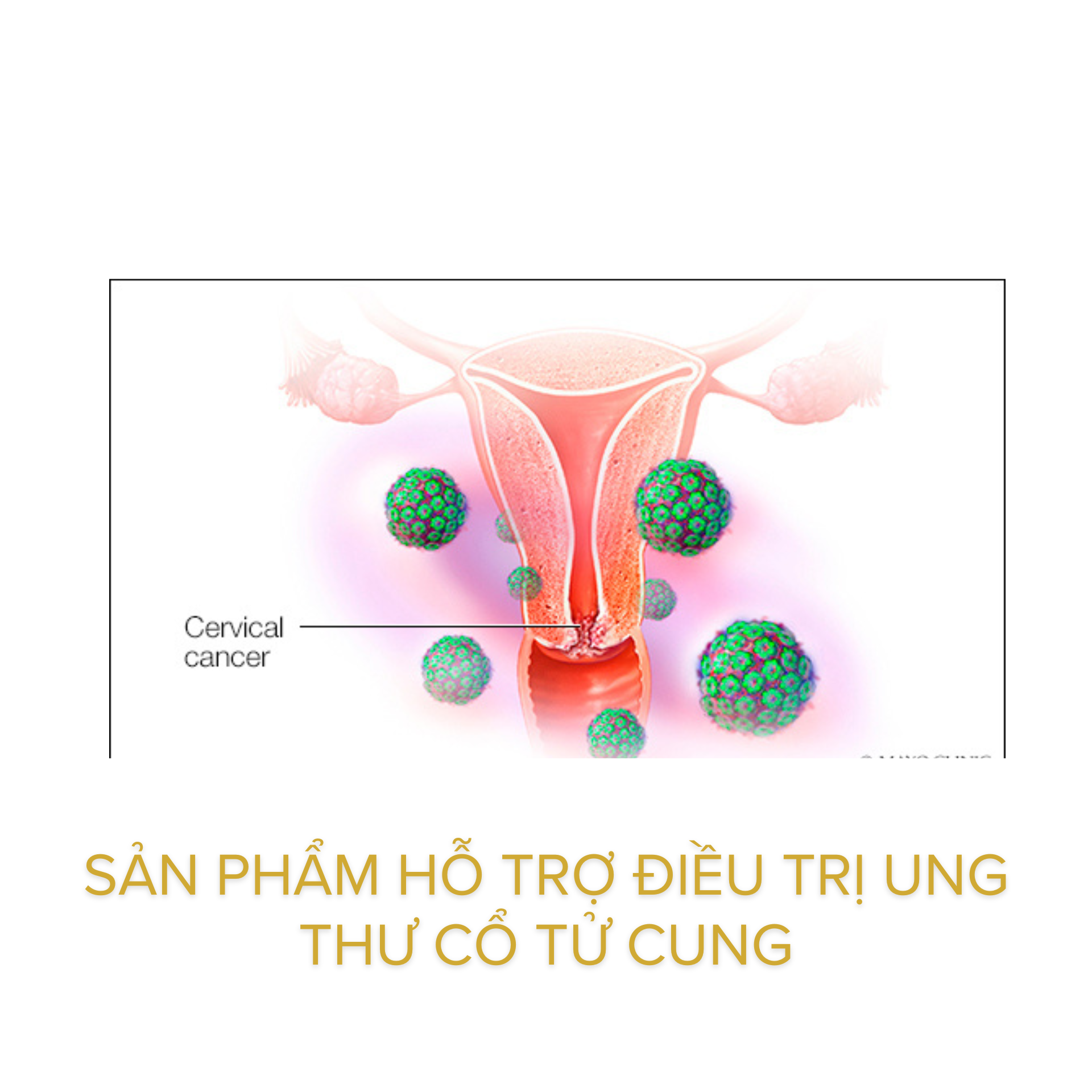 Sản phẩm hỗ trợ điều trị ung thư cổ tử cung