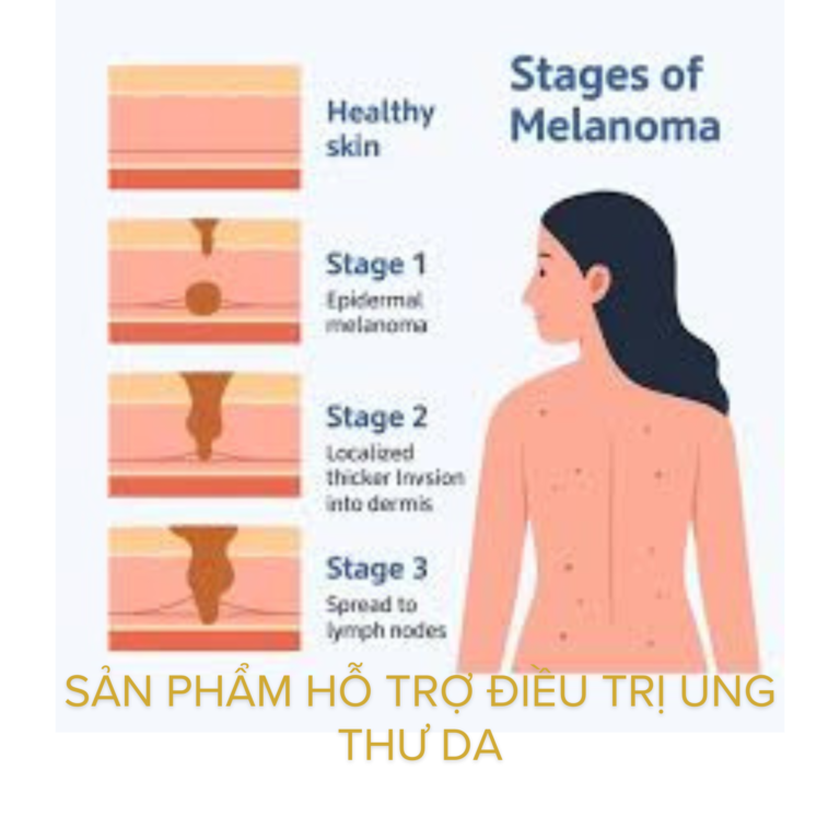 Sản phẩm hỗ trợ điều trị ung thư da tăng cường miễn dịch