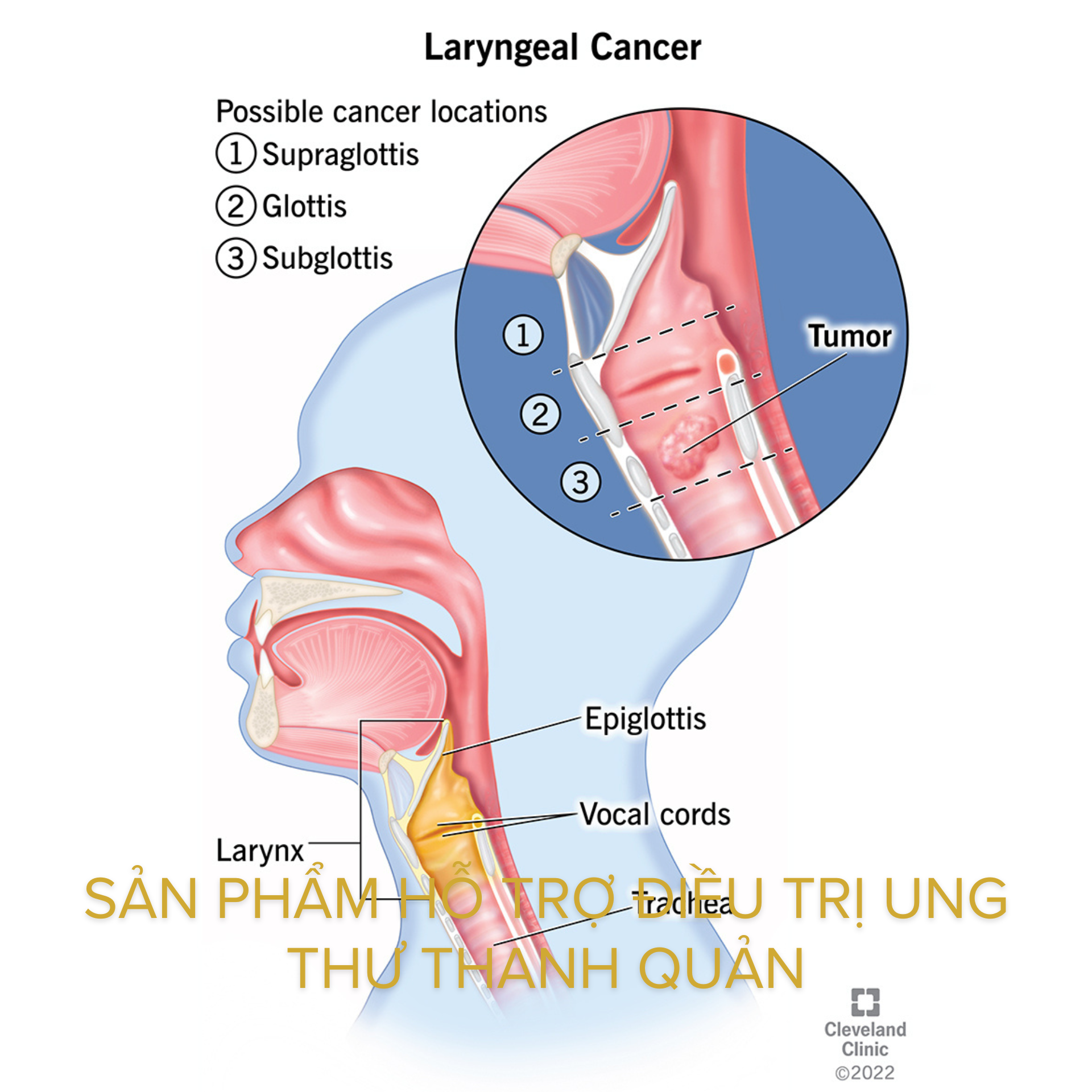Sản phẩm hỗ trợ điều trị ung thư thanh quản