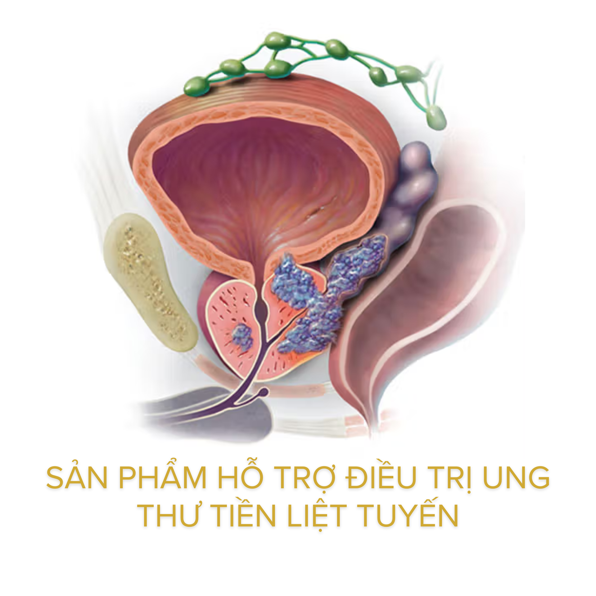 Sản phẩm hỗ trợ điều trị ung thư tiền liệt tuyến