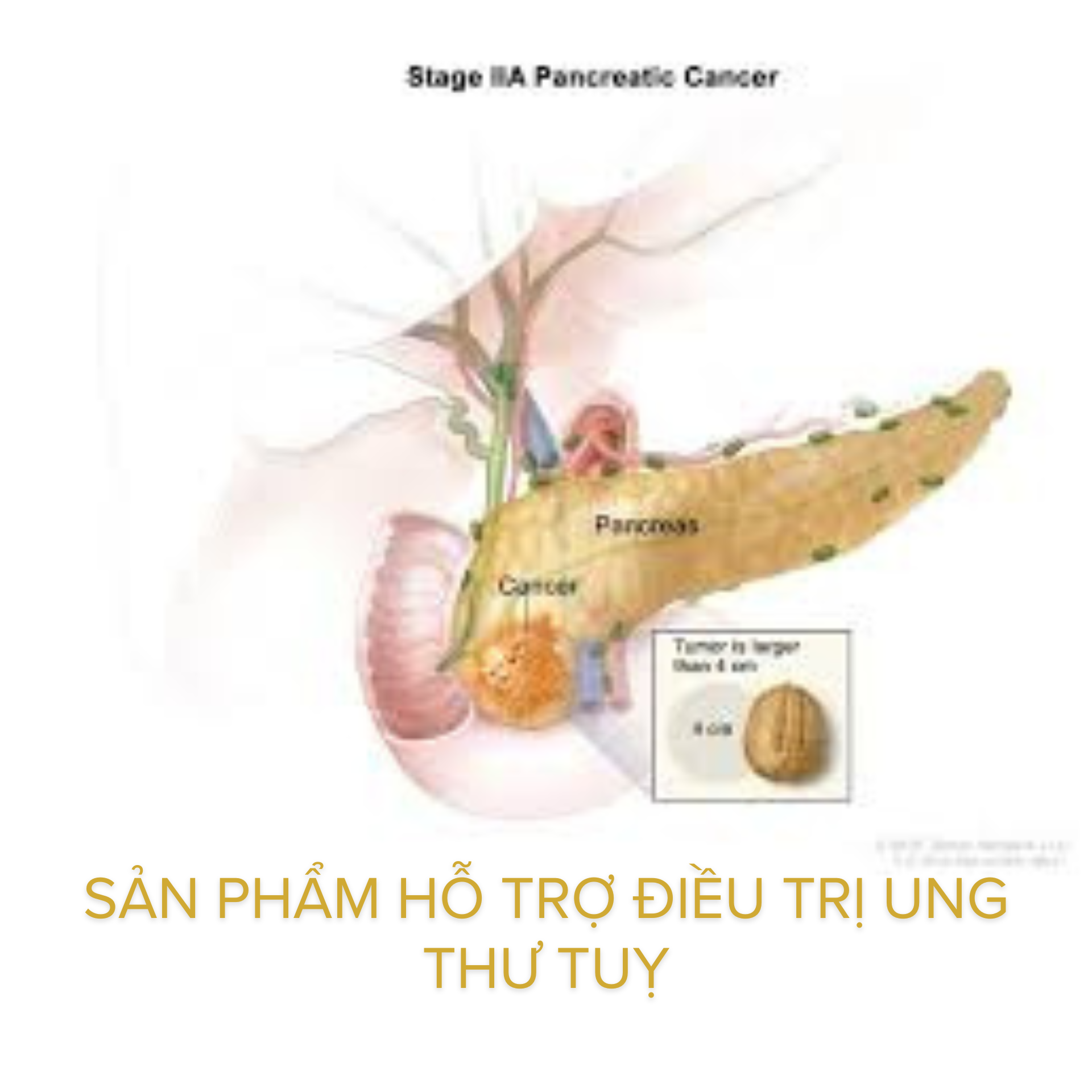 Sản phẩm hỗ trợ điều trị ung thư tuỵ