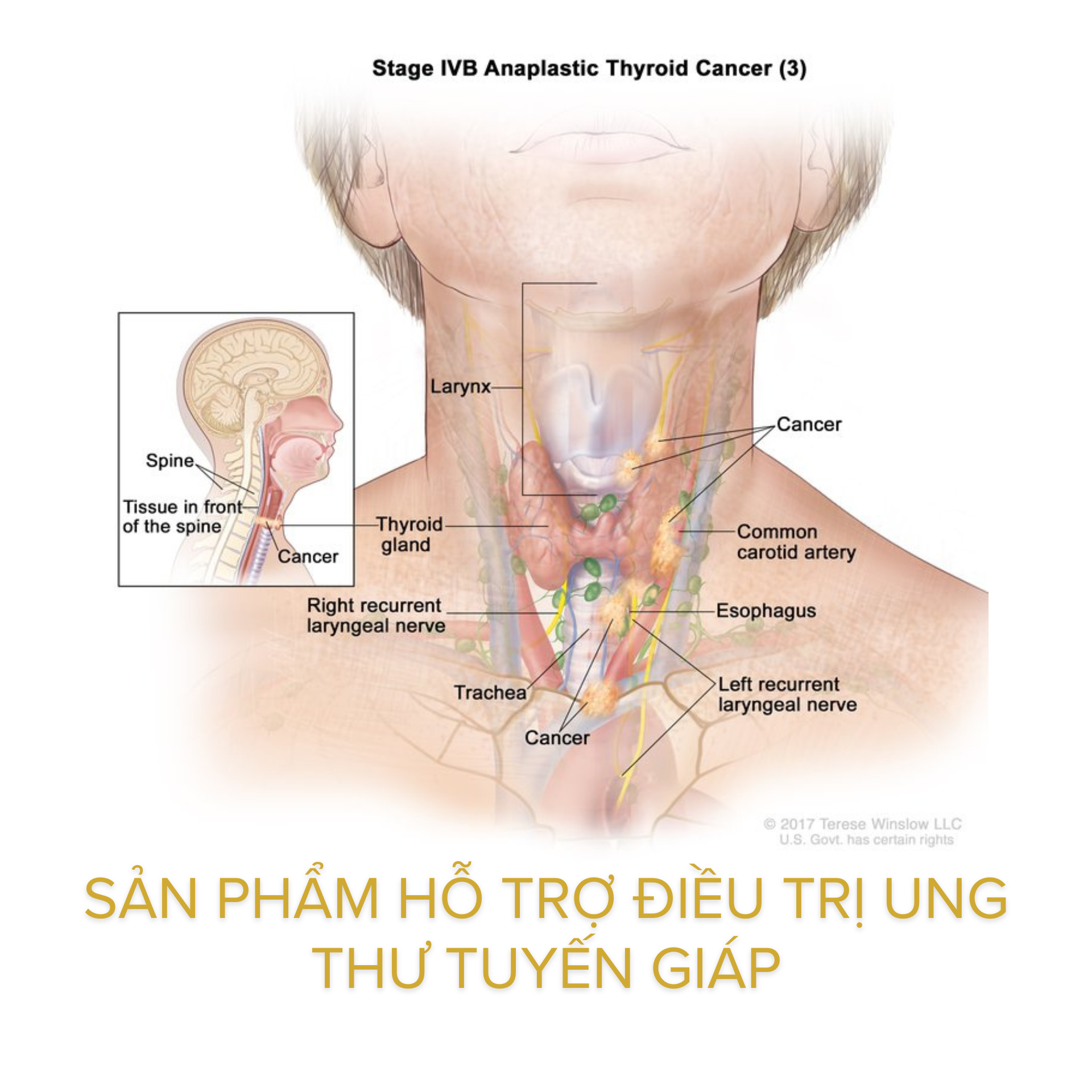 Sản phẩm hỗ trợ điều trị ung thư tuyến giáp