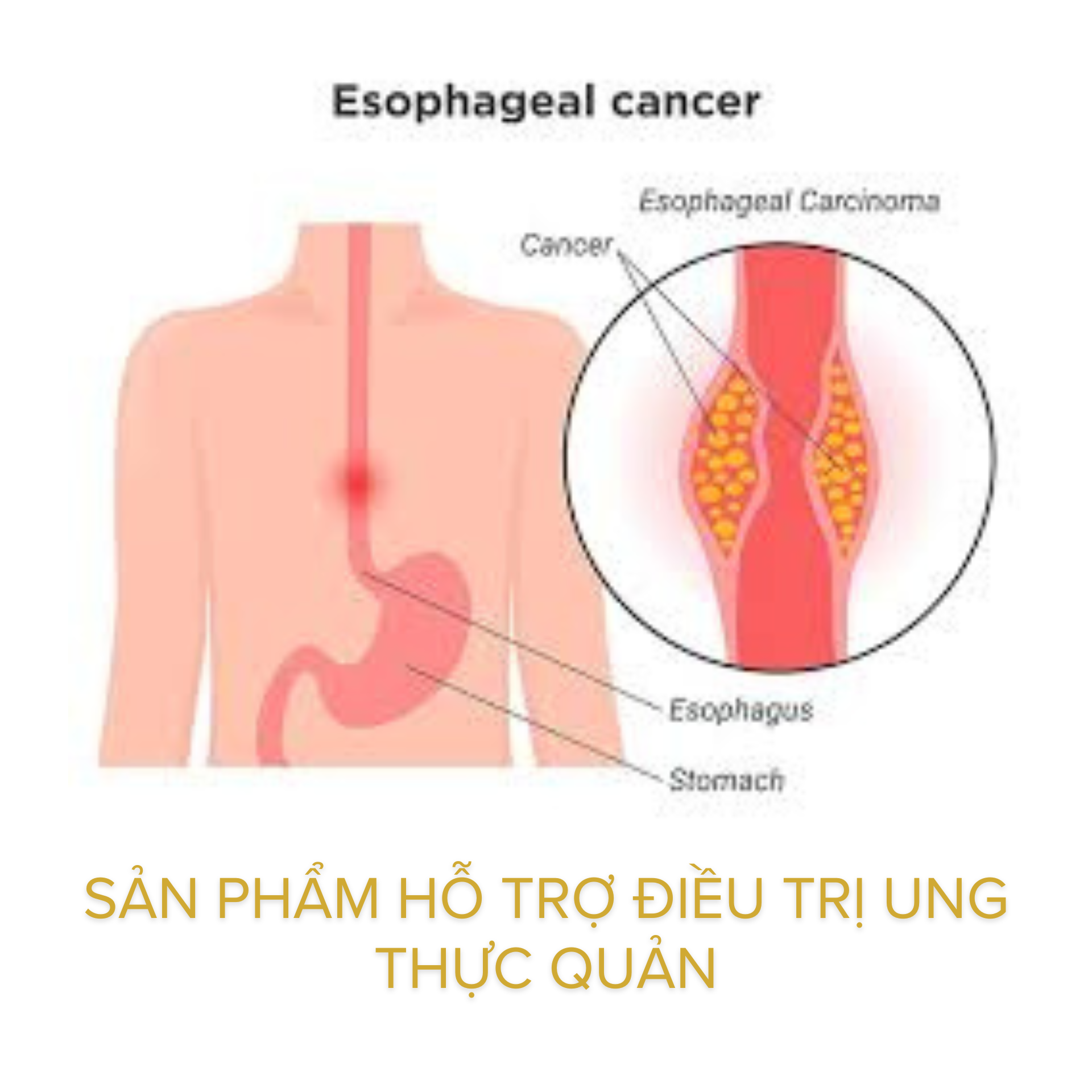 Sản phẩm hỗ trợ điều trị ung thực quản