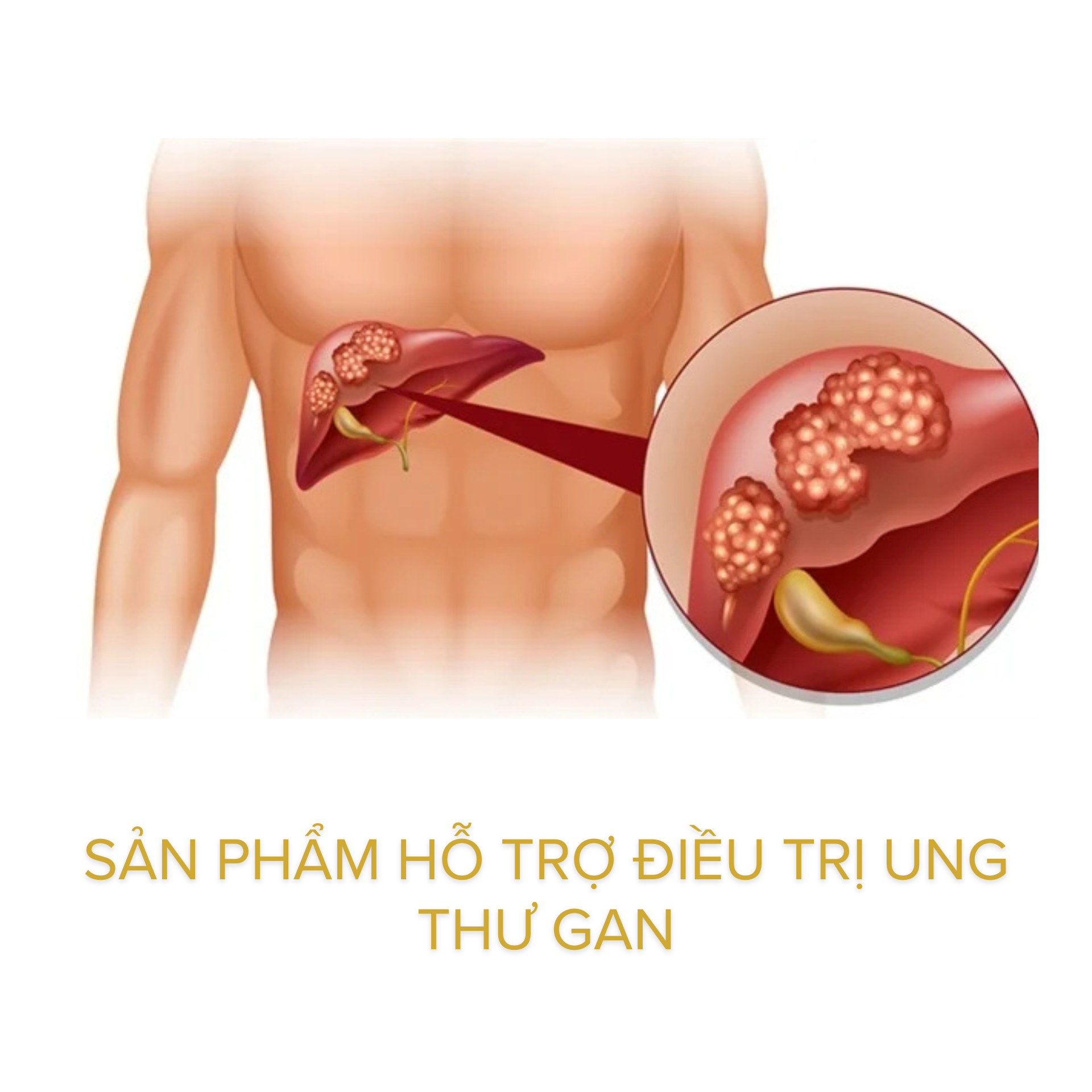 sản phẩm hỗ trợ điều trị ung thư gan