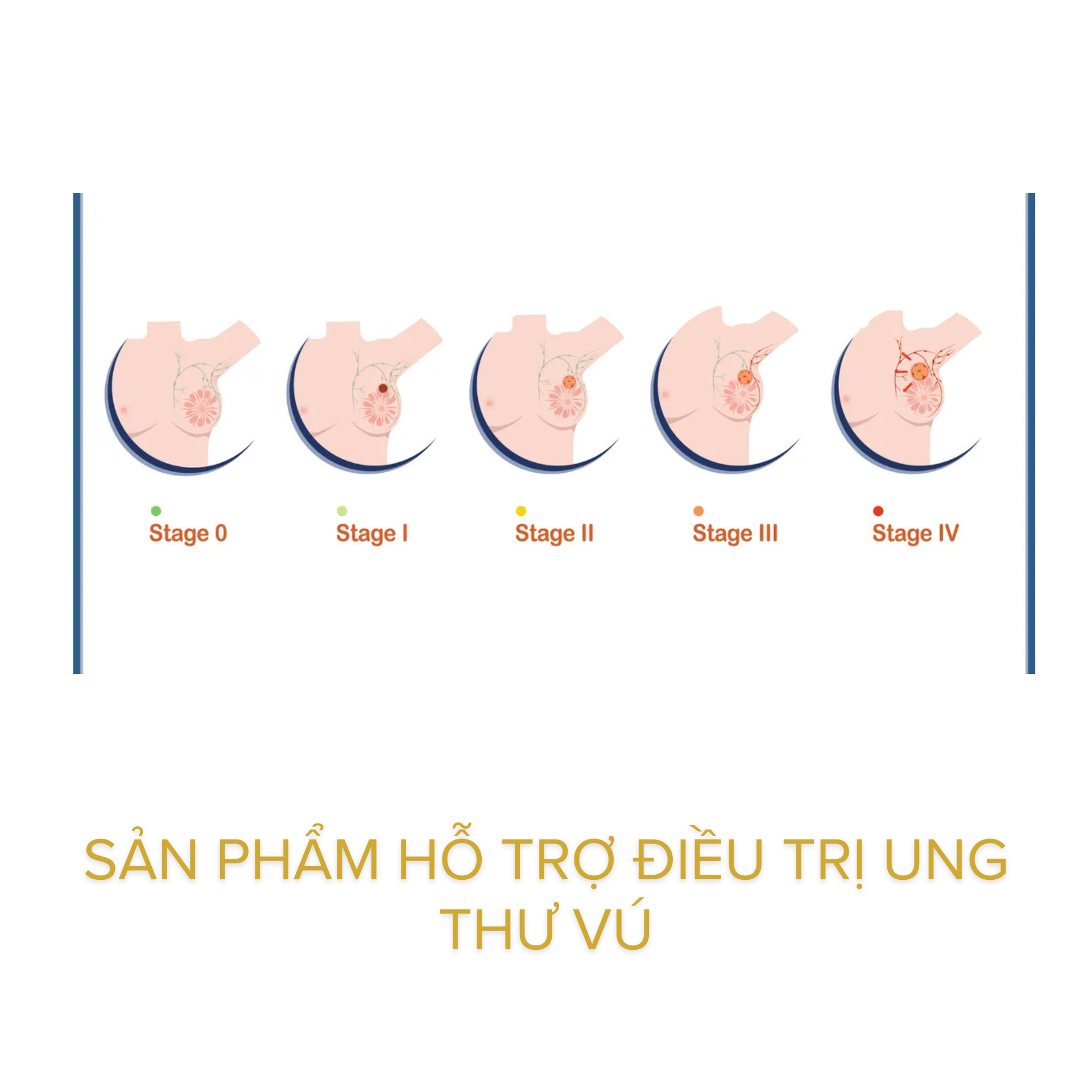 sản phẩm hỗ trợ điều trị ung thư vú