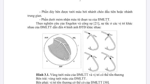 Xác định vị trí tắc động mạch thủ phạm trong STEMI trên ECG